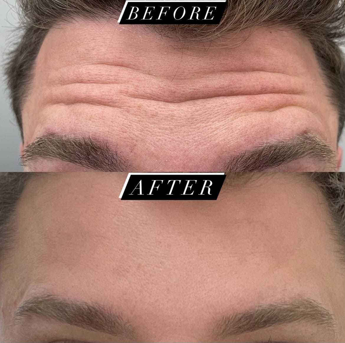 Botox - Regenics - Reduce Fine Lines and Wrinkles