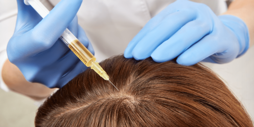 A woman is getting her hair retouched with a syringe for hair restoration.