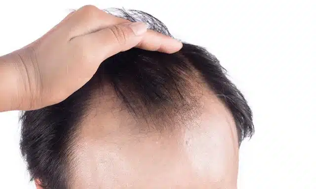 hair loss header