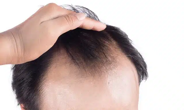 Hair Falling Out It Could Be Telogen Effluvium  Geisinger