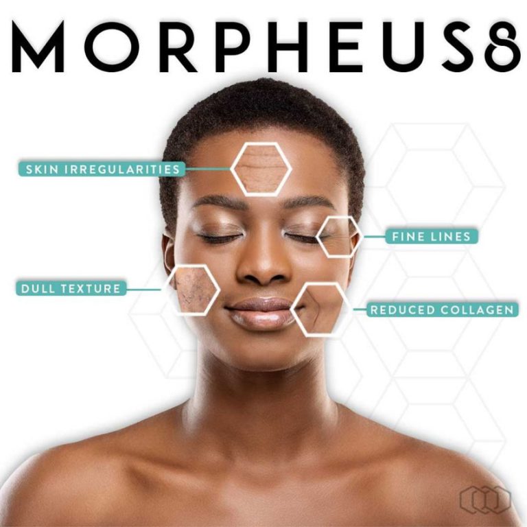 A serene woman's face with labeled hexagons highlighting skin irregularities, dull texture, fine lines, and reduced collagen, promoting morpheus8 treatment.
