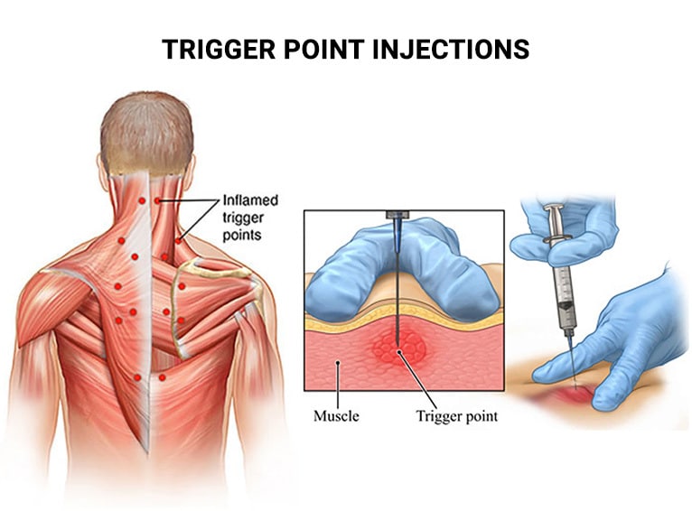 Illustration depicting trigger point injections for muscle pain, showing inflamed areas in neck muscles and a close-up of the injection process.