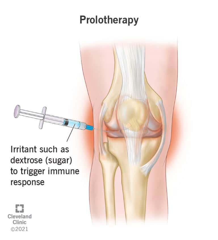 Illustration showing prolotherapy in a knee, where a syringe injects dextrose solution into the joint to stimulate healing.