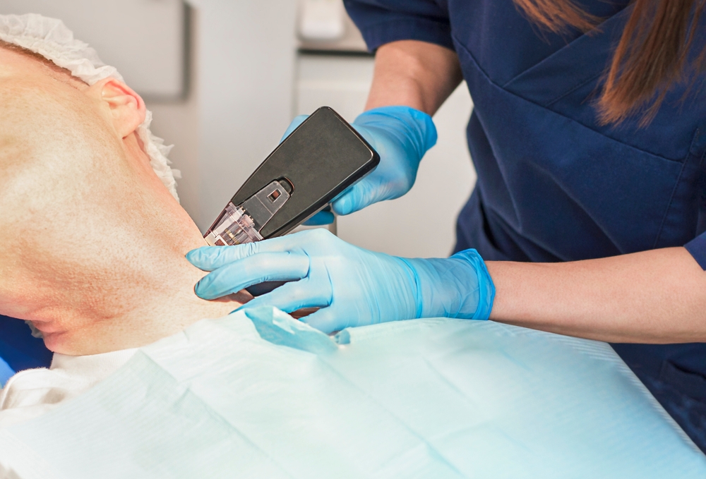 close up of a man having a morpheus8 treatment