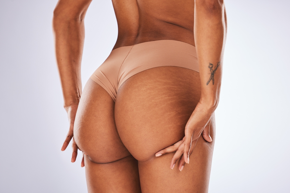 Stretch marks, real and natural buttocks